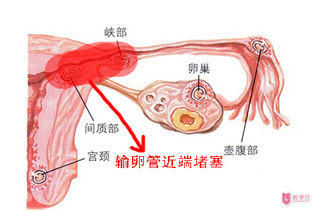 輸卵管堵塞的相關知識，大多數人都不知道這個！